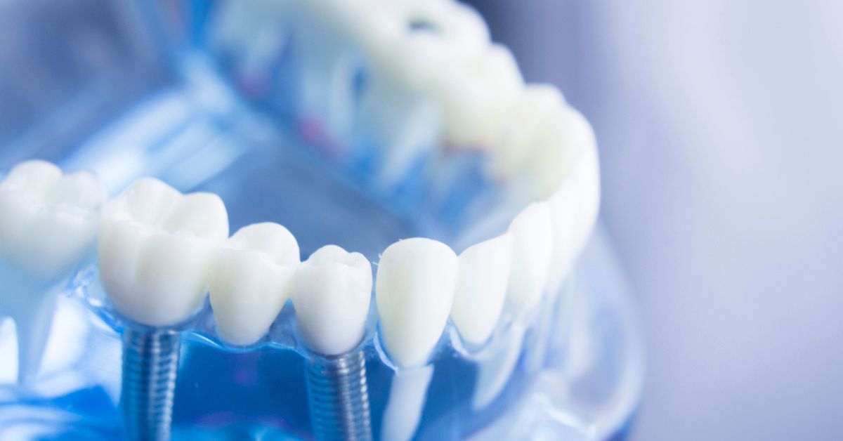 Photo of a model of a person's bottom teeth, with two dental implants.