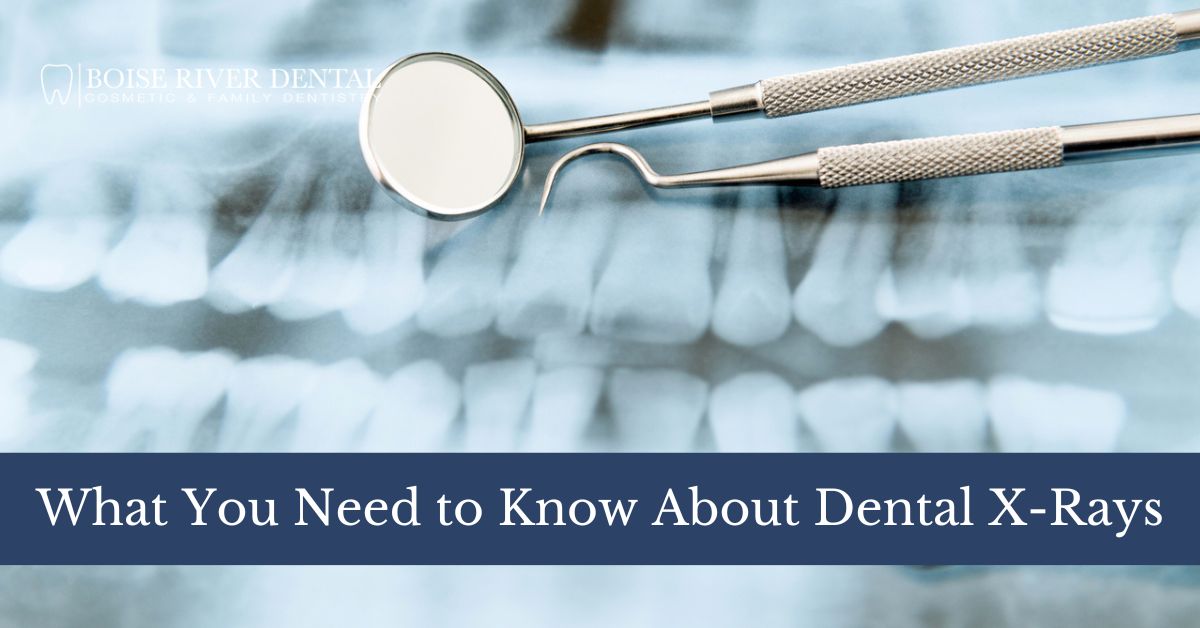 What You Need to Know About Dental XRays Boise River Dental